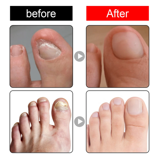 Southmoon Ingrown Toenail Drops Nail Repair Oil (BUY 1 GET 1 FREE🔥🔥)