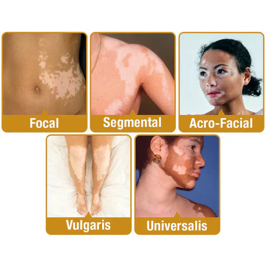 VitiGO™ Bee Venom Corrector Cream - (Buy 1 Get 1 Free🔥🔥)