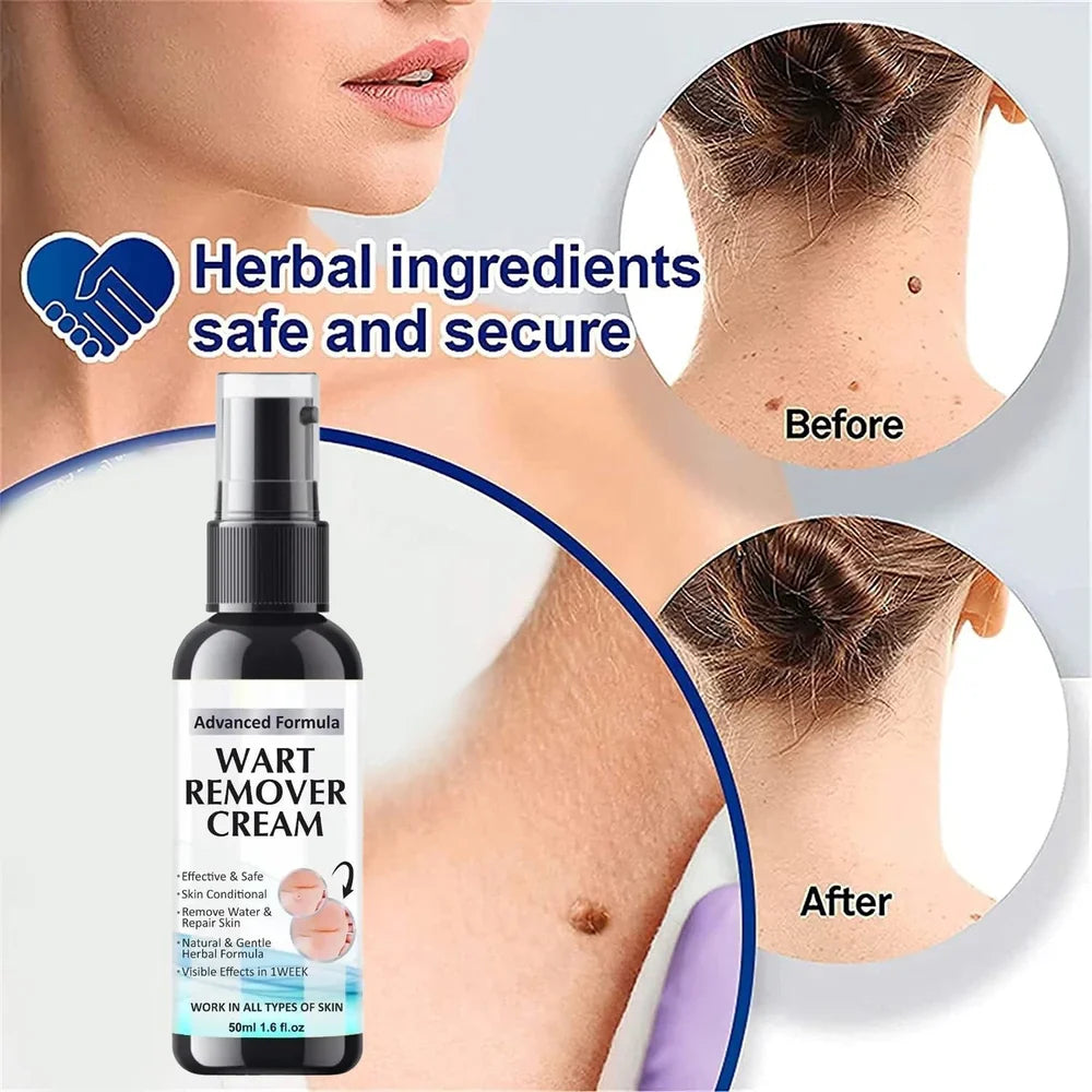 wart remover cream  PACK OF 2