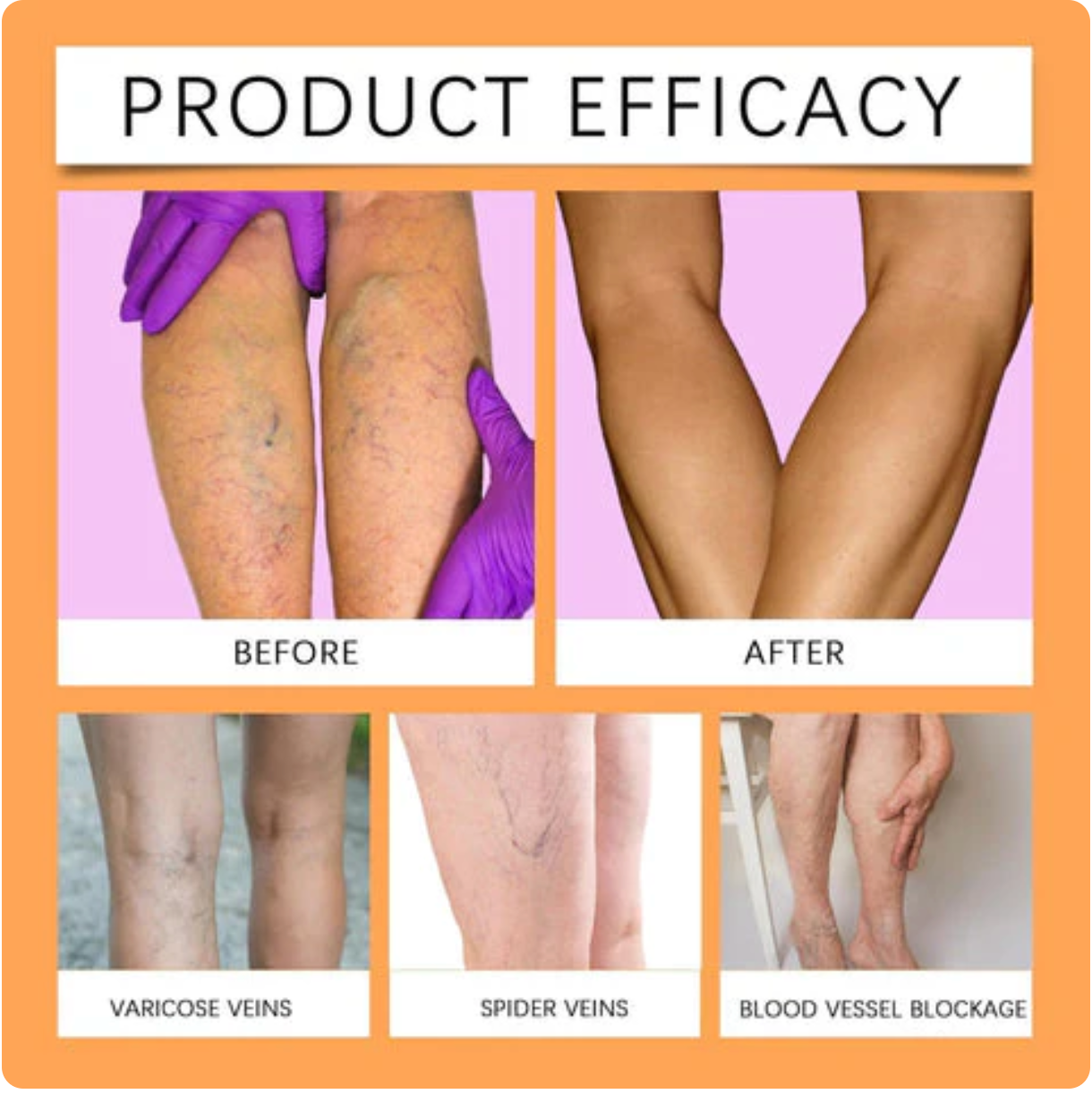 Turmeric Varicose Veins Relief Spray - (Buy 1 Get 1 FREE🔥🔥)