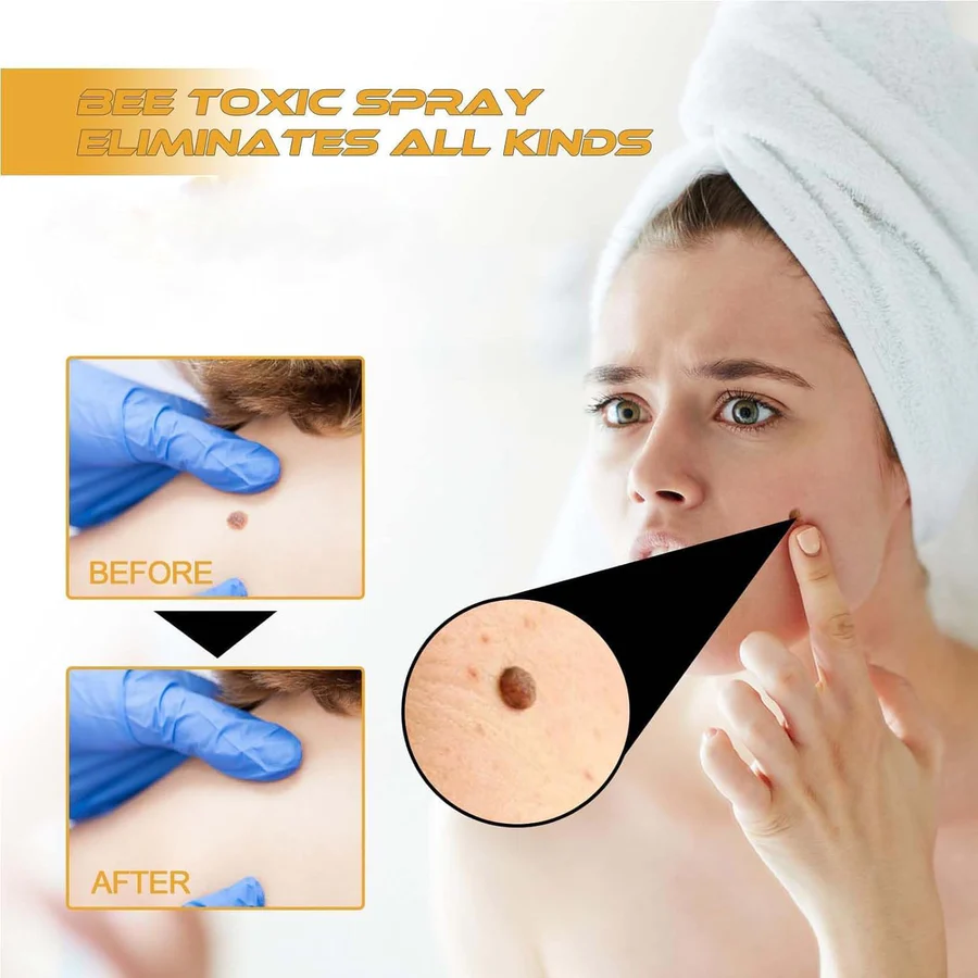 Original Bee Venom Wart & Skin Tag Remover Spray -(Buy 1 Get 1 FREE🔥🔥)
